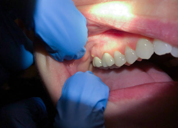 Best Emergency Wisdom Tooth Extraction in Lockport, LA